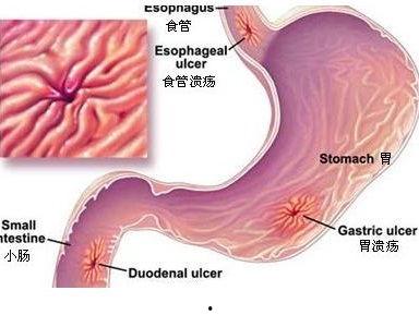 胃溃疡吃角瓜,天然食疗的养胃之道